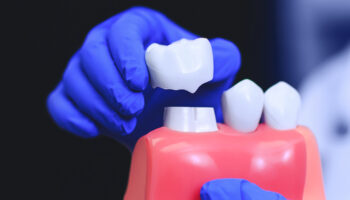 Do Permanent Crowns Fall Out Easily? When to Contact Your Dentist
