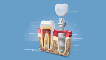 How Do Dental Implants Work? Recovery and What to Expect After Surgery