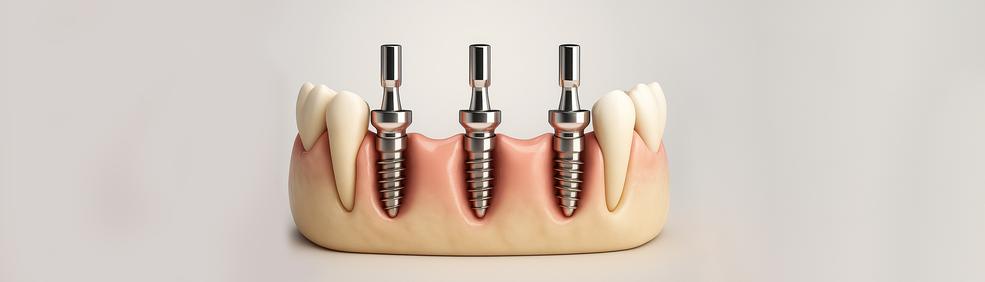 Endosteal Dental Implants