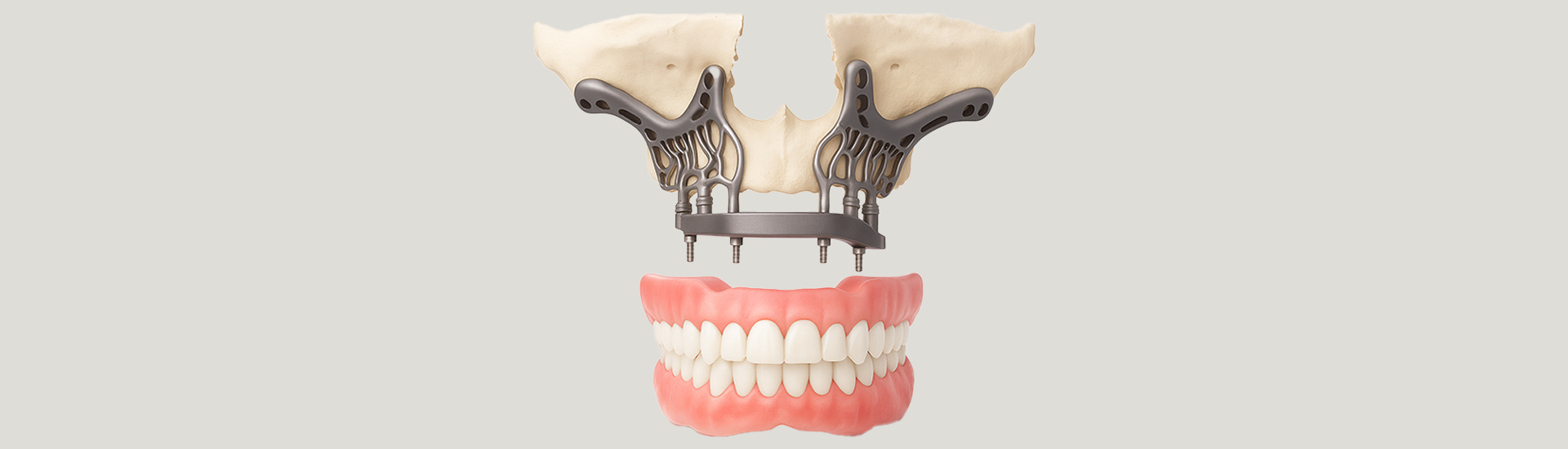 Subperiosteal Dental Implants